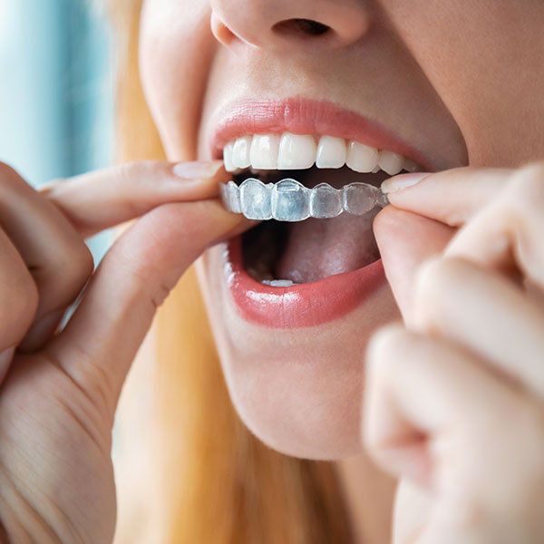 Invisalign Georgetown, ON, Invisalign® Braces Georgetown, ON